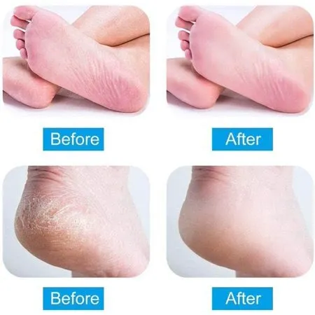 الة تنعيم وازالت التشققات والجلد الميت عندها  pedi vac   - Image 9