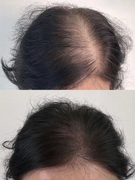 PACK L'huile de romarin + DERMA ROLLER - Image 3