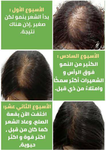 زيت  أكليل الجبل  الأصلي الأمريكي + هدية مجانية  - Image 2