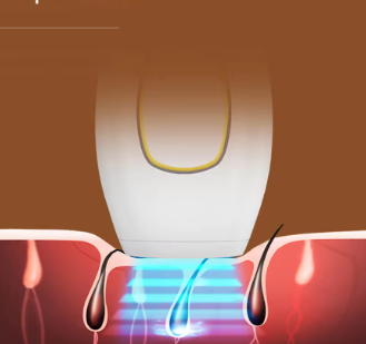 IPL Laser - Image 5