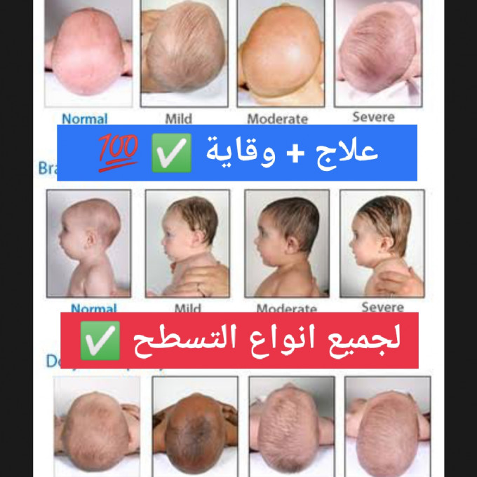 الوسادة الطبية لعلاج تسطح و إنحناء رأس طفلك الأصلية 100% SD S AUD - Image 3