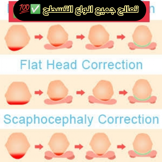الوسادة الطبية لعلاج تسطح و إنحناء رأس طفلك الأصلية 100% SD S AUD - Image 5