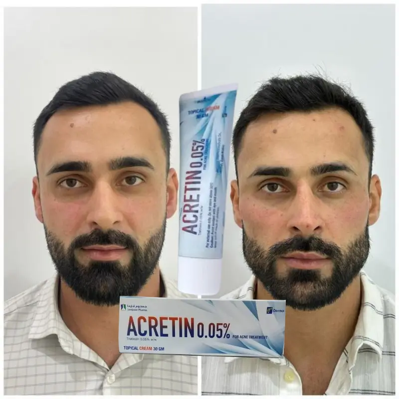 Crème Acretin - لتصغير الأنف - Image 1